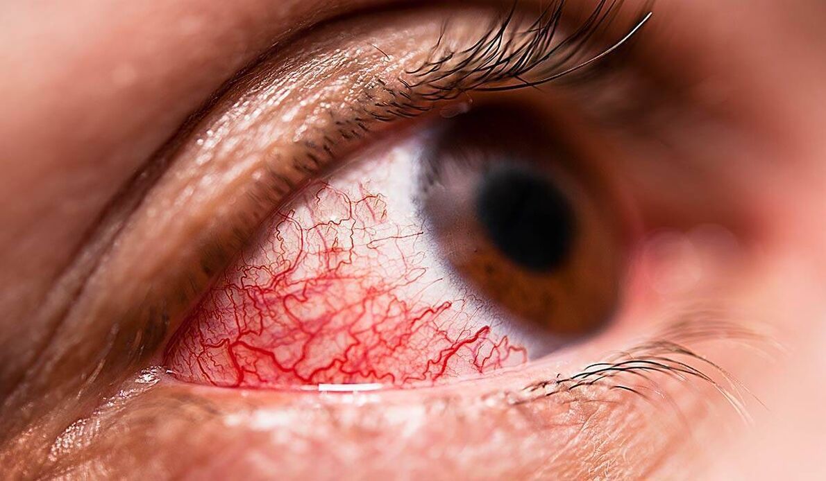 Diyabetik retinopati, diyabetin geç komplikasyonlarından biridir